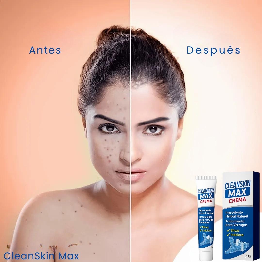 Verrugas Fuera CleanSkin Max