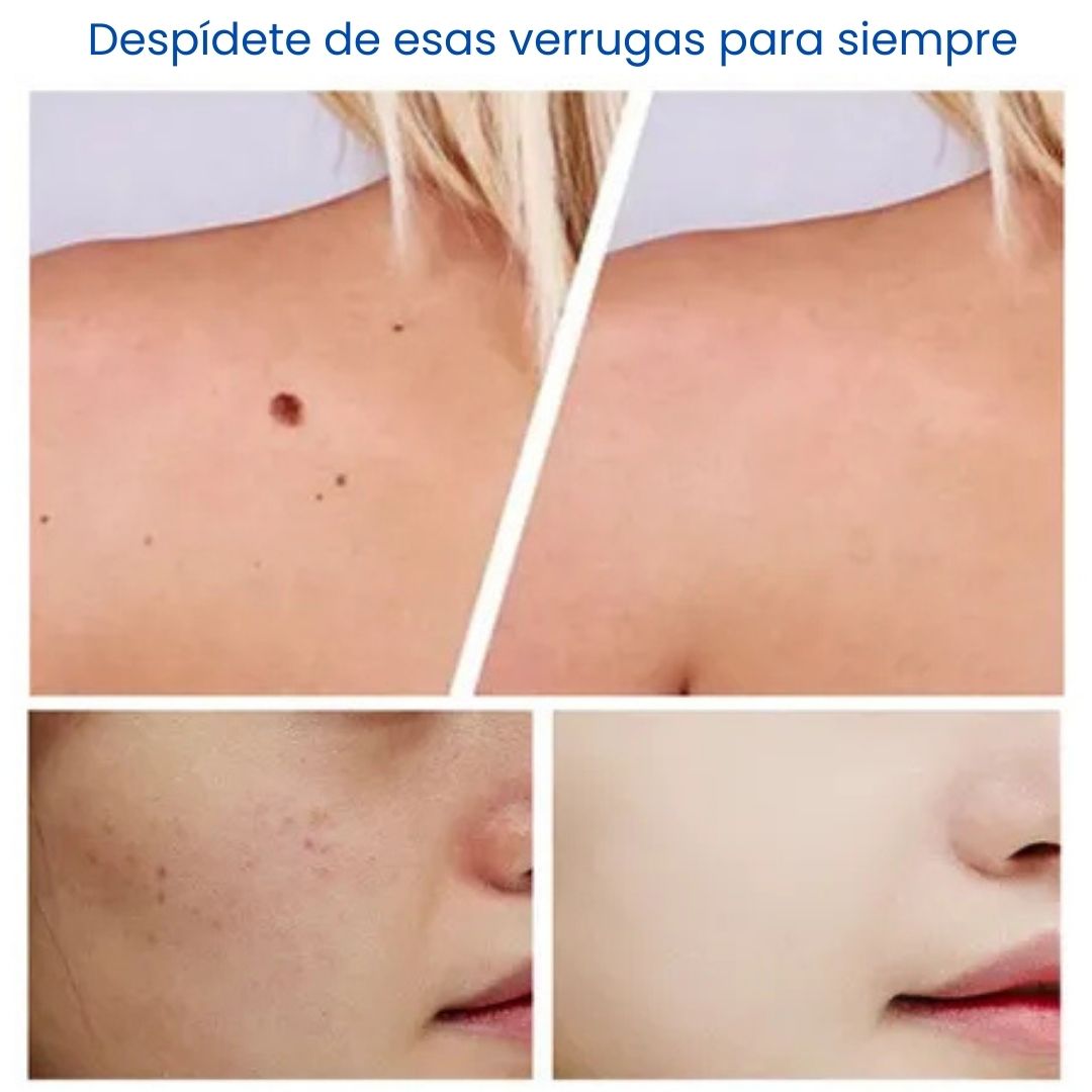 Verrugas Fuera CleanSkin Max