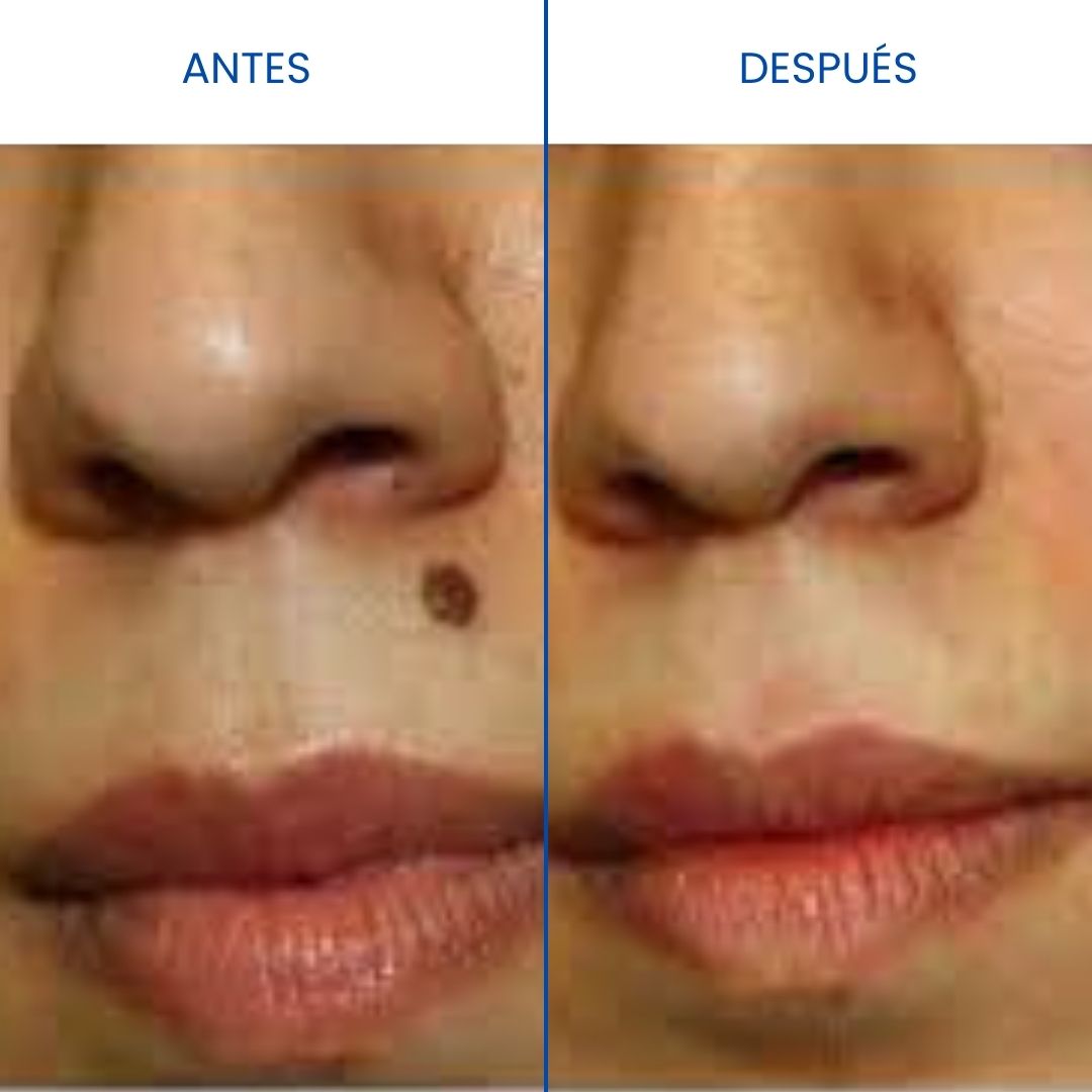 Verrugas Fuera CleanSkin Max