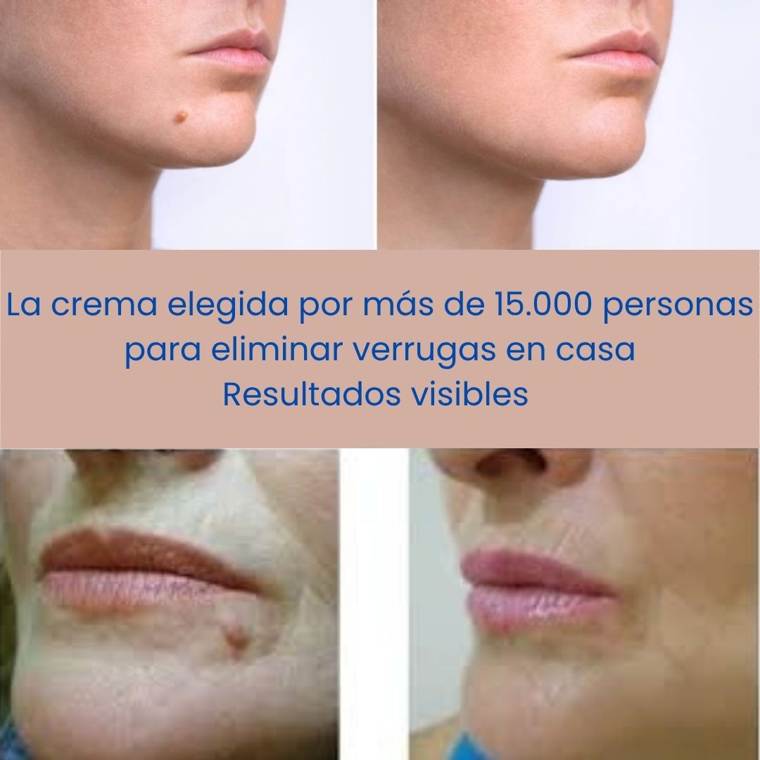 Verrugas Fuera CleanSkin Max
